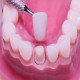 Step-by-Step: What to Expect When Getting Dental Crowns in Houston