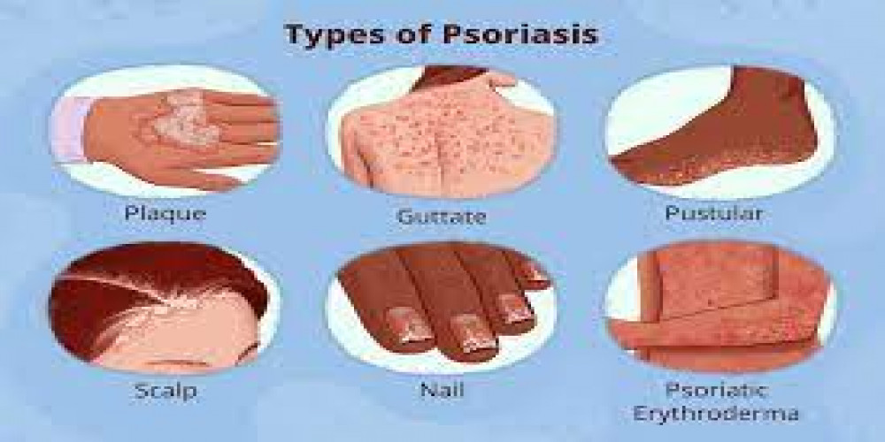Unveiling Psoriasis: A Comprehensive Guide to Understanding This Skin Condition