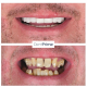 Dental Implant in Turkey: DentPrime Dental Clinic