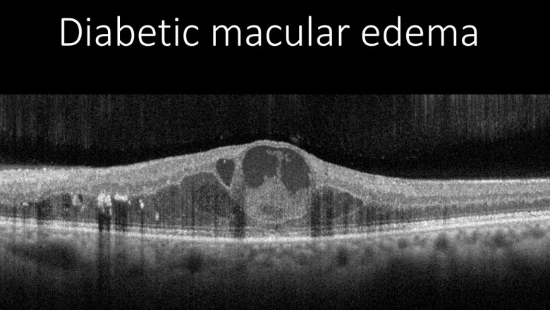 Diabetic Macular Edema Market 2023 | Industry Demand, Fastest Growth, Opportunities Analysis and Forecast To 2032
