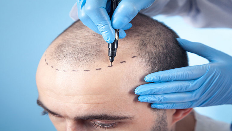 Your Journey to Fuller Hair: FUE Hair Transplant in Islamabad