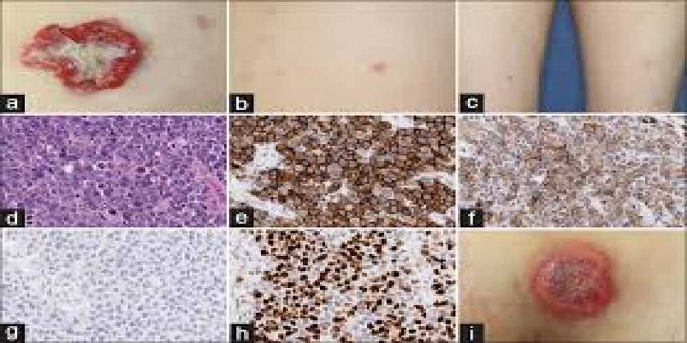 Anaplastic Large Cell Lymphoma Market 2023 Size, Dynamics & Forecast Report to 2032