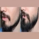 Abu Dhabi's Secret to Impeccable Beards | The Art of Hair Transplantation