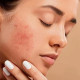 Flawless Faces | Unlocking Acne-Free Confidence in Abu Dhabi