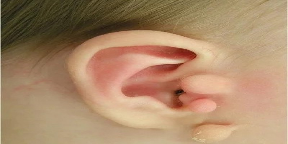 Erase Imperfections | The Ultimate Guide to Preauricular Tag Removal in Abu Dhabi