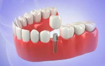 The Complete Guide to Dental Implants: Restoring Your Smile with Confidence
