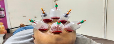 Hijama Treatment Center: Restoring Health Through Cupping Therapy Services