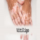 Vitiligo Market Demand Analysis, Statistics, Industry Trends And Investment Opportunities To 2032