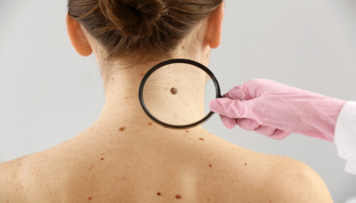 Skin Cancer Treatment Market Size, Growth & Industry Research Report, 2032