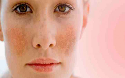 Laser Treatment for Melasma in Dubai: Effective Solutions for Skin Pigmentation