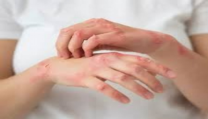 التغلب على العقبات في علاج الأمراض الجلدية