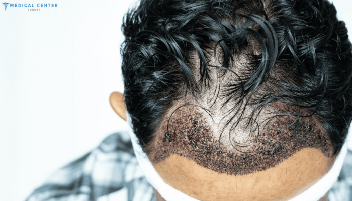 Reclaim Your Youthful Look with DHI Hair Implantation in Dubai