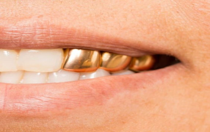Golden Confidence: Dubai's Permanent Teeth Trend