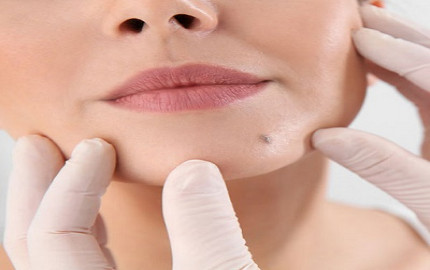 10 Moves toward Benefit from Mole Removal Treatment in Dubai
