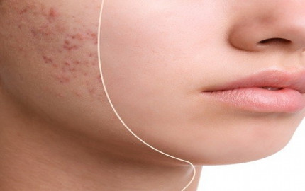 Acne Scar Treatment in Islamabad: A Comprehensive Guide