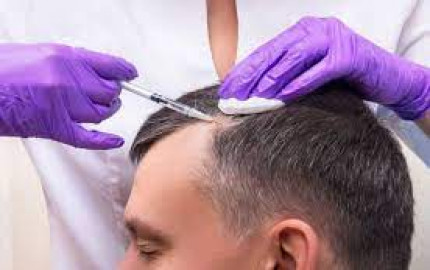 Dubai's FUE Hair Transplant Experts: Leaders in Hair Restoration