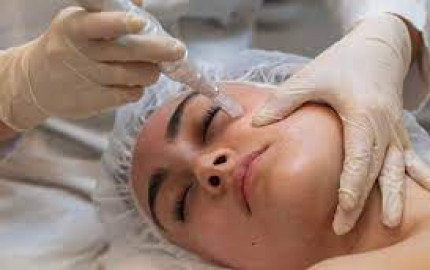 Microneedling: A Revolutionary Approach to Skin Rejuvenation