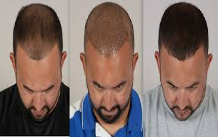 FUE Hair Transplant: A Modern Solution to Hair Loss