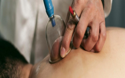 Experience Wellness: Your Guide to Hijama Treatment