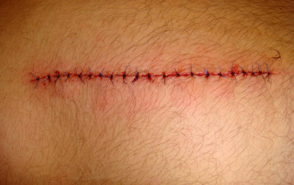 How to Properly Remove Sutures at Home in Dubai: A Comprehensive Guide