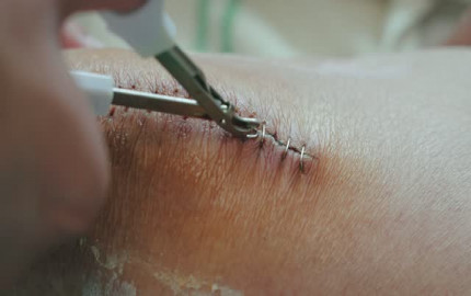 Suture Removal At Home in Dubai: A Step-by-Step Guide for Dubai Residents