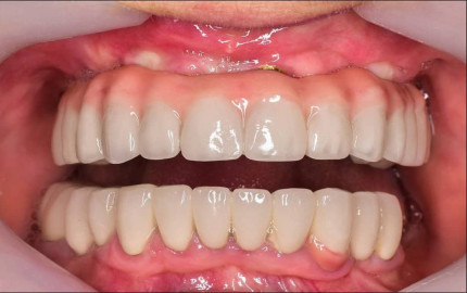 Complete Dental Makeover: Full Mouth Rehabilitation in Dubai