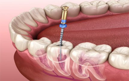 Expert Tips for Recovering After Root Canal Treatment in Dubai