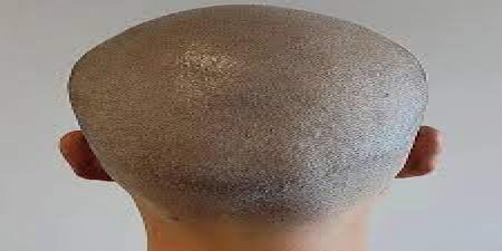  How much should I pay for Scalp Micropigmentation Treatment in Dubai?
