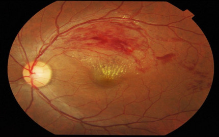 Retinal Vein Occlusion Treatment Market: A Comprehensive Outlook on Dynamics, Key Players, and Industry Projections till 2028 by TechSci Research