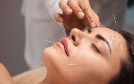 Top 10 Benefits of Acupuncture Therapy You Need to Know