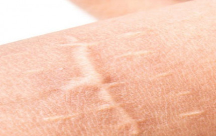 Revive Your Skin: Scar Camouflage in Dubai