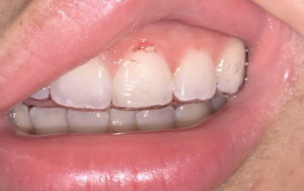 Gum Bleeding: Exploring Underlying Dental Conditions