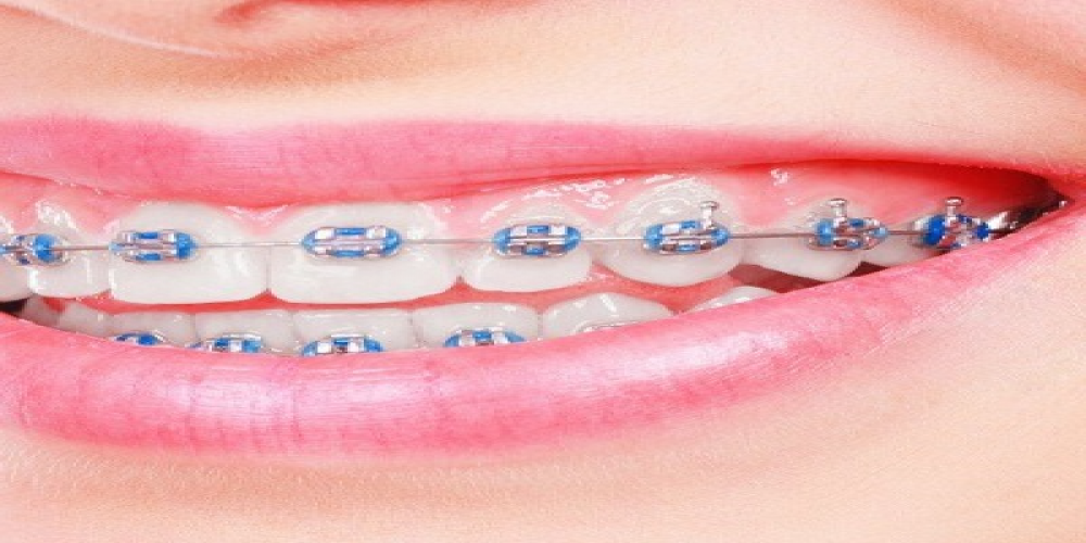 A Complete Guide to Dental Braces: What to Expect in Dubai