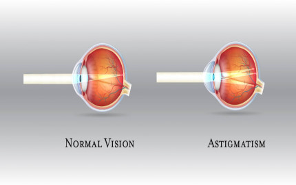 Astigmatism Market Size, Trends And Forecast To 2034