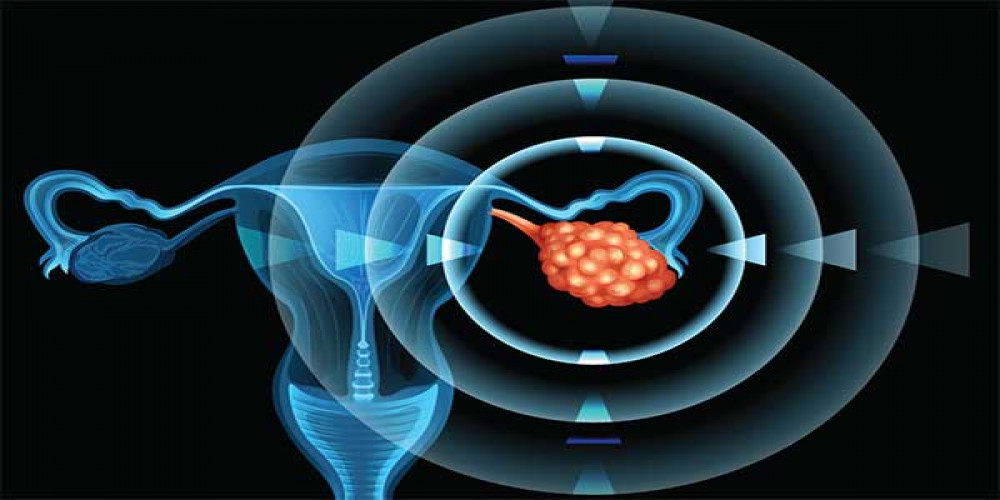 2024, Epithelial Ovarian Cancer Market | Industry Analysis Till 2034
