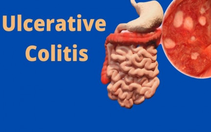 Ulcerative Colitis Market Demand Analysis, Statistics, Industry Trends And Investment Opportunities To 2032
