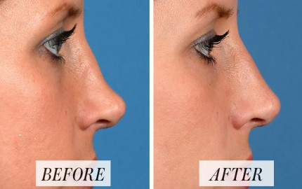 Experience the Ultimate Nose Transformation: Dermal Fillers