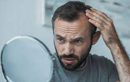  10 Things to Know Before Getting FUE Hair Transplant