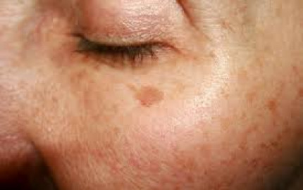 The Lasting Solution: Can Melasma Treatment Wipe Out Dark Spots for Good