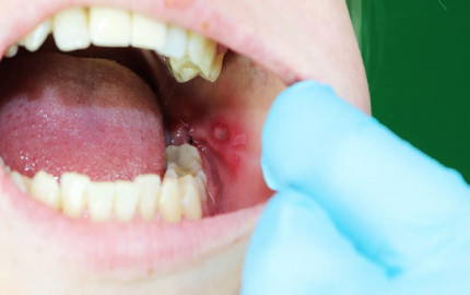 Mouth Ulcer Treatment Market 2024-2032: Industry Size, Share, Growth Drivers, Opportunities