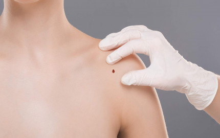 Risks of Skin Lesion Removal