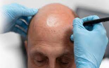  10 Common Myths About DHI Hair Implantation