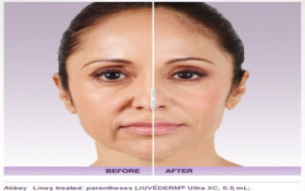 Dubai's Guide to Juvederm Fillers: Regain Your Youthful Look