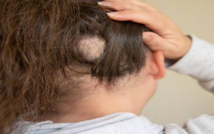 10 Ideas for Treating Alopecia Areata in Dubai