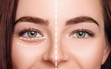 Unveiling the youthful you: Under Eye Fillers in Dubai