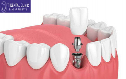 Orthodontic Advancements: The Latest Trends in Braces and Aligners