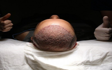 Revitalize Your Look: The Ultimate Guide to Hair Transplant