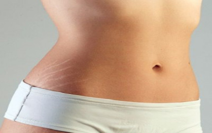 Weight Loss Secrets: Do Stretch Marks Stay or Go?