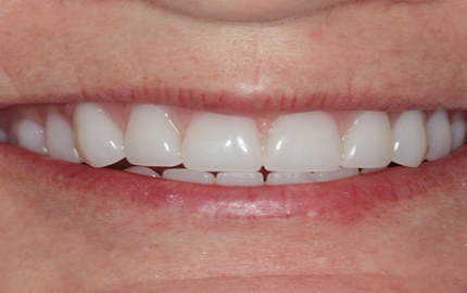 Exploring the Benefits of Dental Implants vs. Dentures in Dubai