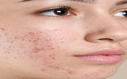 What Are My Treatment Options for Acne and Acne Scarring?